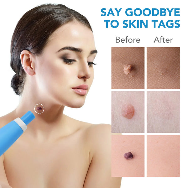 Easy Skin Tag Remover Kit